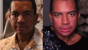 Bruno Gaga se submete a harmonização facial