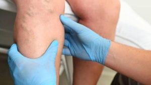 Brasil bate recorde de hospitalizações por trombose venosa