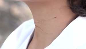 Menino de 9 anos é atingido por corda de kitesurf em praia de São Luís