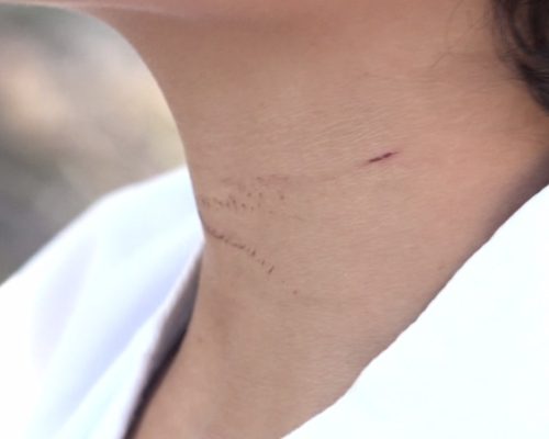 Menino de 9 anos é atingido por corda de kitesurf em praia de São Luís