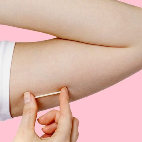 Rede básica de saúde passa a oferecer implante contraceptivo de alta eficácia em São Luís