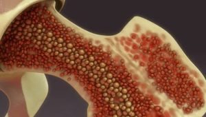 Maranhão registra seu primeiro transplante de medula óssea